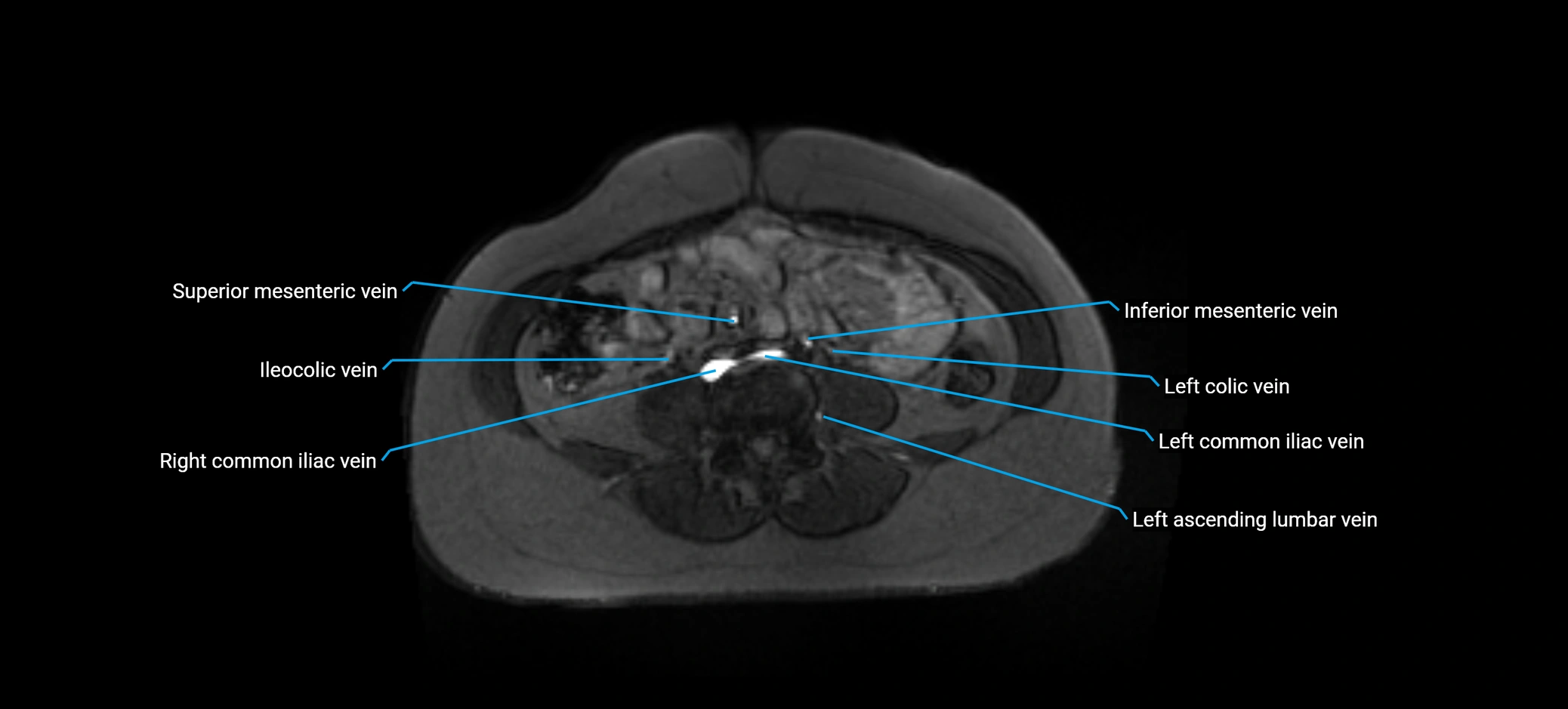MRV abdomen pelvis & lower limb axial cross sectional anatomy labelled MRI image 115 (1).webp